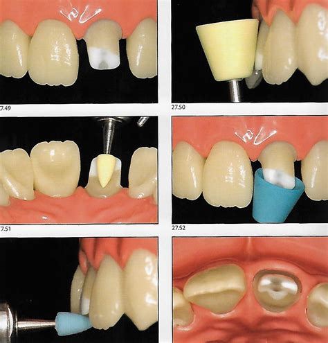 Anterior Crown Preparation | Dental Esthetics