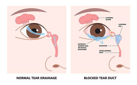 Tear Duct Surgery Oceanside | Oculoplastics Carlsbad, CA