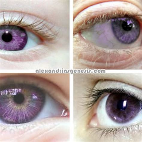 Alexandrias Genesis Purple Eyes Syndrome Pictures - Alexandria’s Genesis