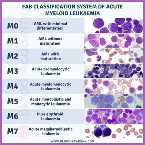 Acute Myeloid Leukemia - Ask Hematologist | Understand Hematology