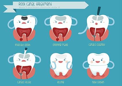 Can a Root Canal Be Done Through a Crown? Expert Guide