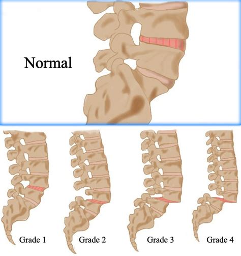 SPONDYLOLISTHESIS - Care2Cure Physiotherapy & Rehab Center