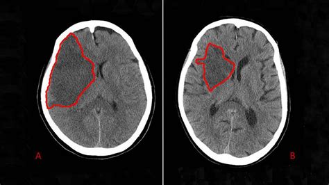 Does Additional MRI Help CT-Diagnosed Stroke Patients? | MedPage Today