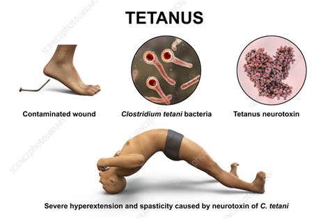 Mechanism of tetanus disease, illustration - Stock Image - F036/6662 ...