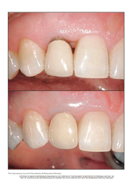 (PDF) Microsurgical Technique for Augmentation of the Interdental ...