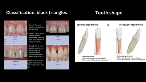 Black triangles, who did it? - Orthodontics in Summary