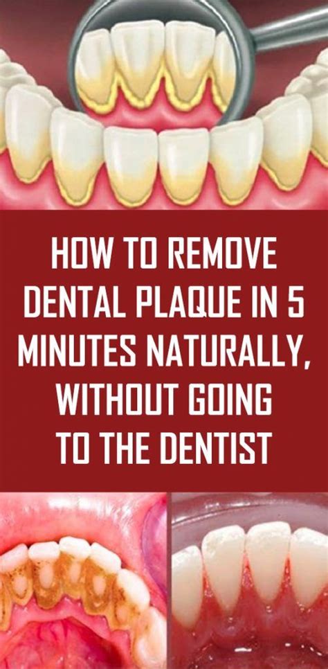 HOW TO REMOVE DENTAL PLAQUE IN 5 MINUTES NATURALLY, WITHOUT GOING TO ...