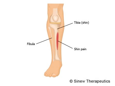 Shin Splints Periostitis Information - Sinew Therapeutics