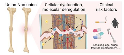 Bioengineering | Free Full-Text | Bone Healing Gone Wrong: Pathological ...