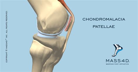 Patellofemoral Chondromalacia On Clearance, Save 53% | jlcatj.gob.mx