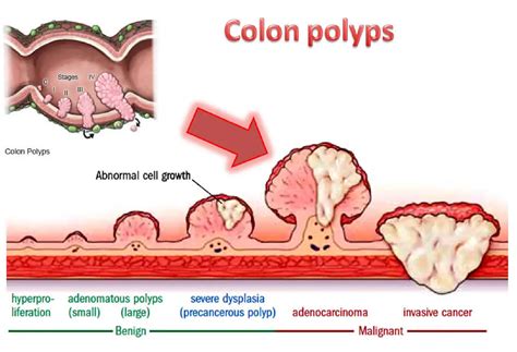 Colon Polyp Size And Type Charts, 55% OFF