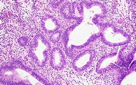 Endometrial hyperplasia without atypia - MyPathologyReport.ca