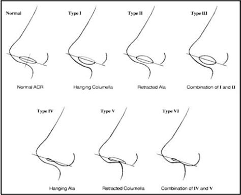 A nose is said to have increased “columella show” when more than 4 ...