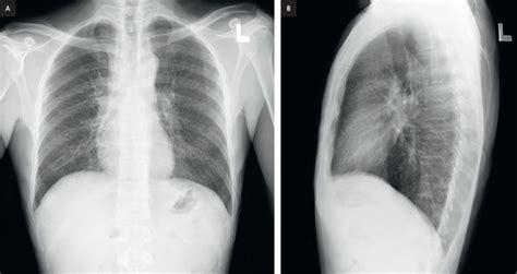 21-year-old male patient with fever and hemoptysis | Chest X-Ray ...