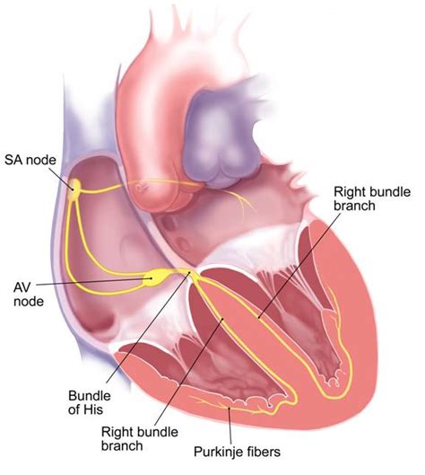 Health Care Information: Supraventricular arrhythmia