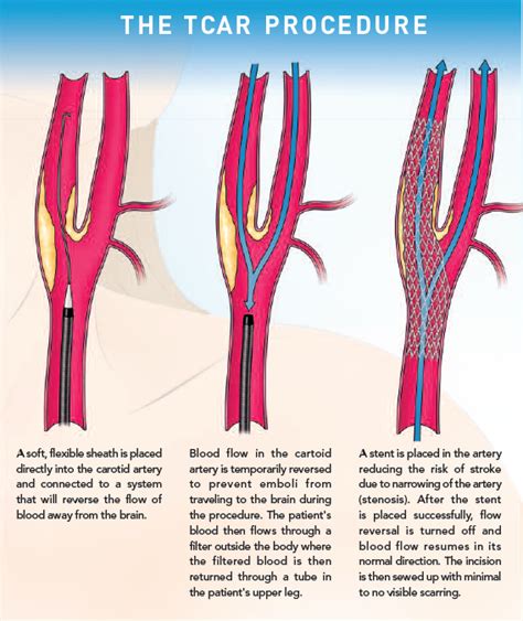 TransCarotid Artery Revascularization - St. Clair Health