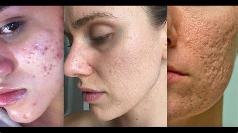 7 Best Acne Scar Treatments Recommended by Dermatologists – Available Ideas