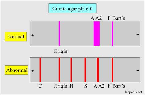 Hemoglobin:- Part 2 - Hemoglobin Electrophoresis, (Hb electrophoresis ...