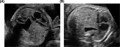 Congenital Diaphragmatic Hernia Ultrasound