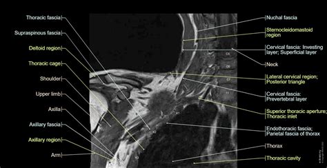 Brachial plexus MR: normal anatomy | e-Anatomy