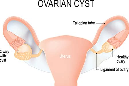 Ovarian cysts | HonorHealth