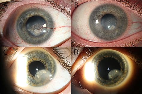 Use of Radiofrequency Diathermy for the Treatment of Chronic Corneal ...