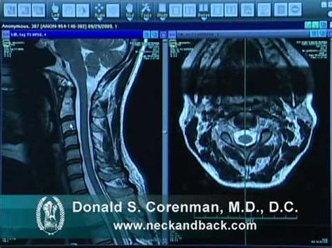 Abnormal Cervical Spine Mri