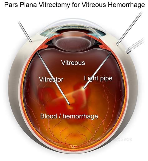 Pars plana vitrectomy illustration featuring PPV on a vitreous hemorrhage