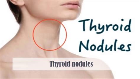 Thyroid Nodules - Causes, Symptoms, Ultrasound, Surgery