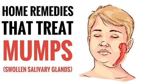 Top 6 Home Remedies To Treat Mumps