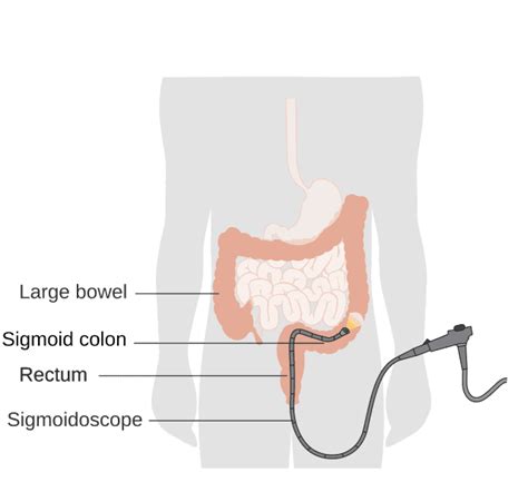 Sigmoidoscopy - Wikiwand