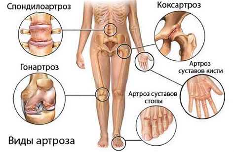 Causes, symptoms of arthrosis, its complications and treatment methods ...