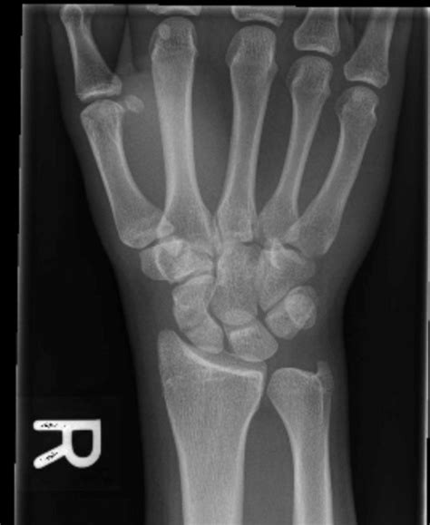 Hand and Wrist Fractures – Undergraduate Diagnostic Imaging Fundamentals