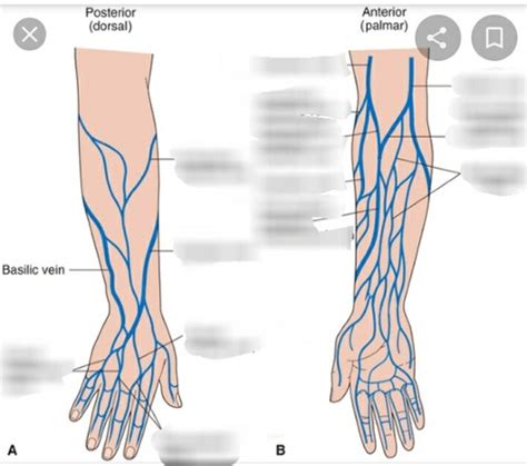 Radial Artery-second Dorsal Metacarpal Vein Arteriovenous, 58% OFF