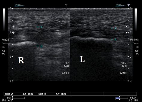 Ultrasound Images of Plantar Fasciitis - Ankle, Foot and Orthotic Centre