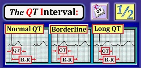 ECG Interpretation: ECG Blog #89 (Basic Concepts-2) – Intervals (PR-QRS-QT)