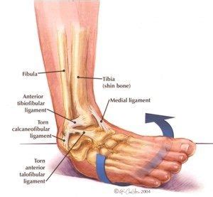 Chronic Ankle Instability