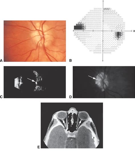 Optic disc drusen - American Academy of Ophthalmology