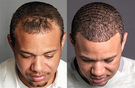 Hair Transplant Before/After Results for Men - Bosley Hair Transplant