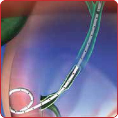 DeviceMD - ReSolve® Biliary Locking Drainage Catheters