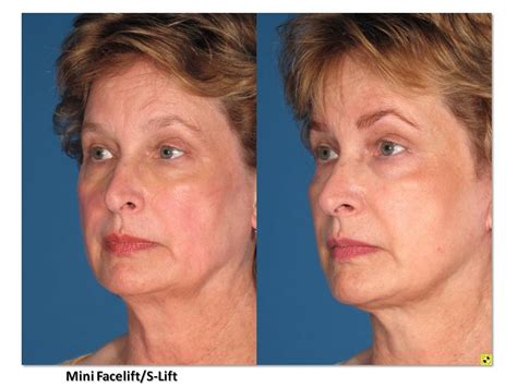 Mini Facelift/S-Lift Before & After Photos - Summit Plastic Surgery ...