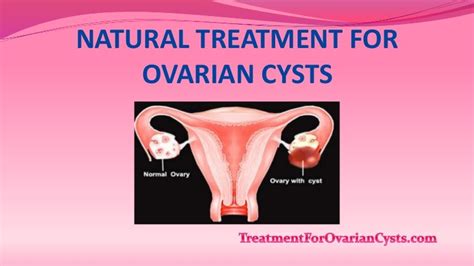 Holistic Treatments For Ovarian Cysts Without Surgery