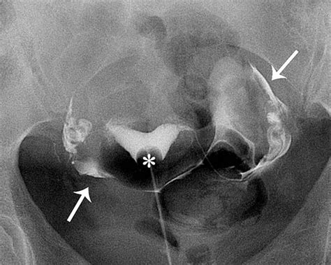 Can I Take Tylenol Before A Ct Scan With Contrast - paradetips