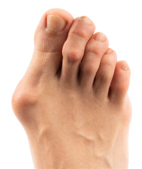 Bunions: Causes, Types, and Treatments | Canyon Oaks Foot & Ankle