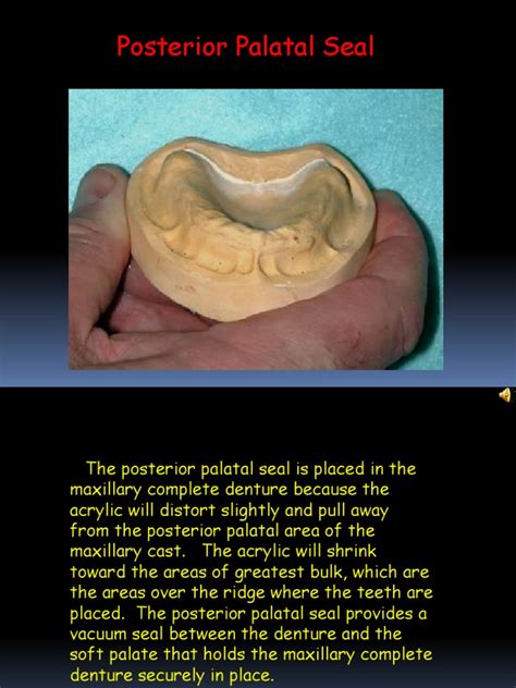 Making A Posterior Palatal Seal | PDF | Dentures | Anatomical Terms Of ...