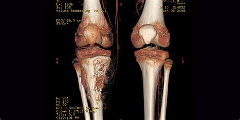 Boom hoffen Zwang cancer de rodilla Verhalten Leere Viele gefährliche ...