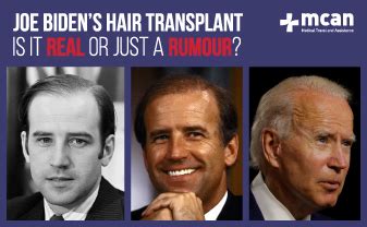 Everything About Joe Biden Hair Transplant