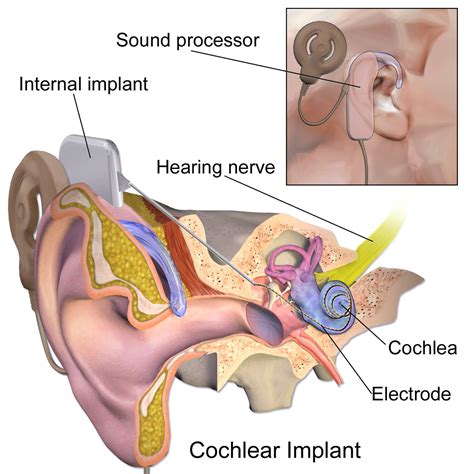 Cochlear implant - Wikipedia