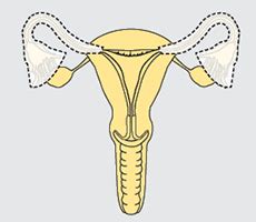 Surgery for Cervical Cancer | Cancer Council NSW