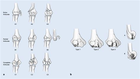 8 Classification of fractures of the distal humerus.a AO classification ...